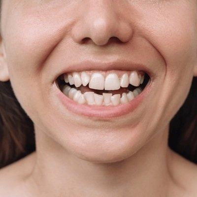 Understanding Crowded Teeth Treatments for a Straighter Smile