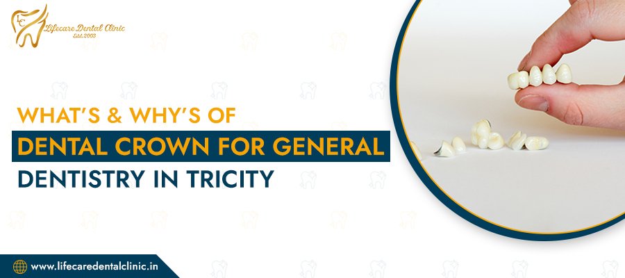 What’s-&-Why’s-of--Dental-Crown-for-General-Dentistry-in-Tricity