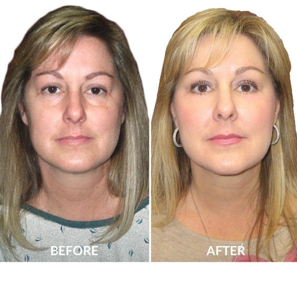 Neck Liposuction