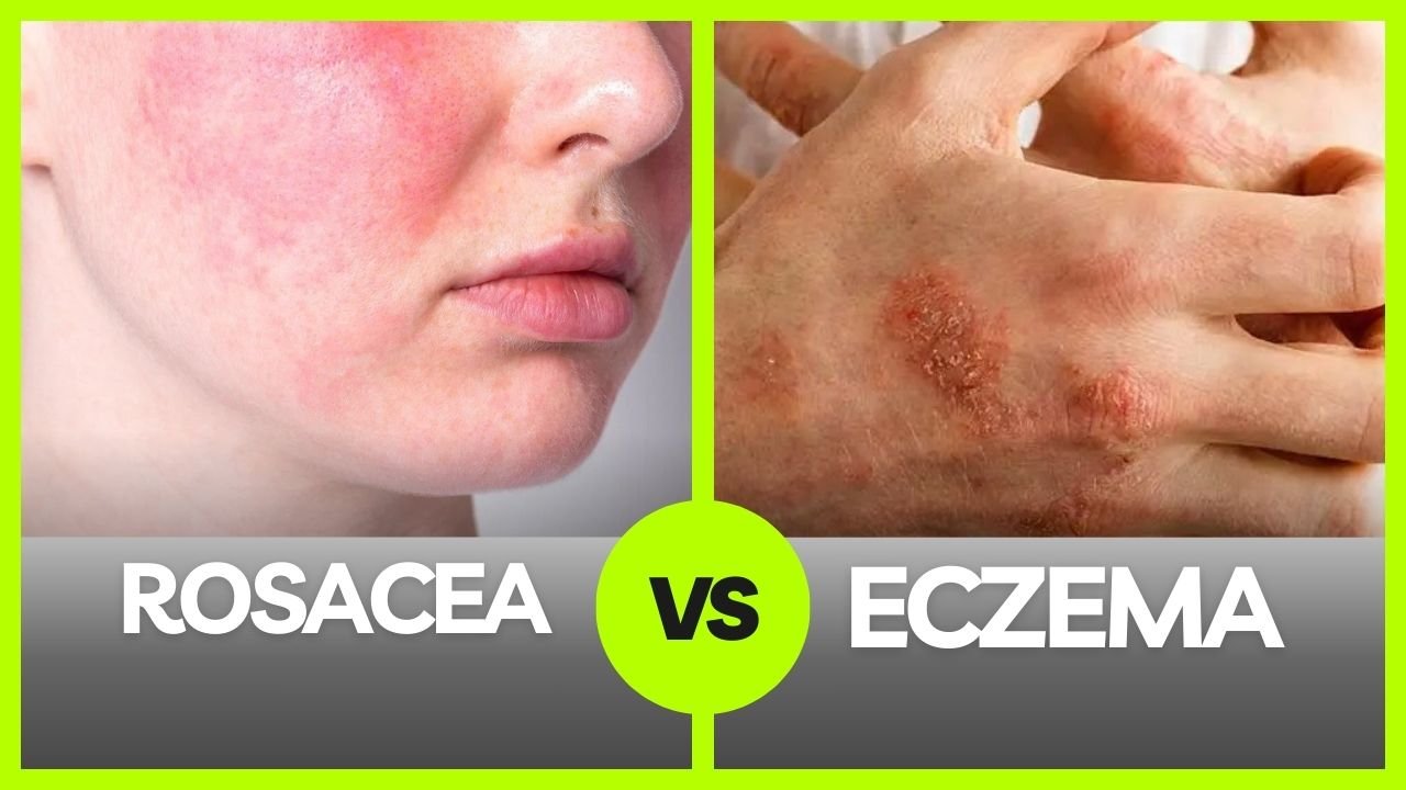 eczema vs. rosacea