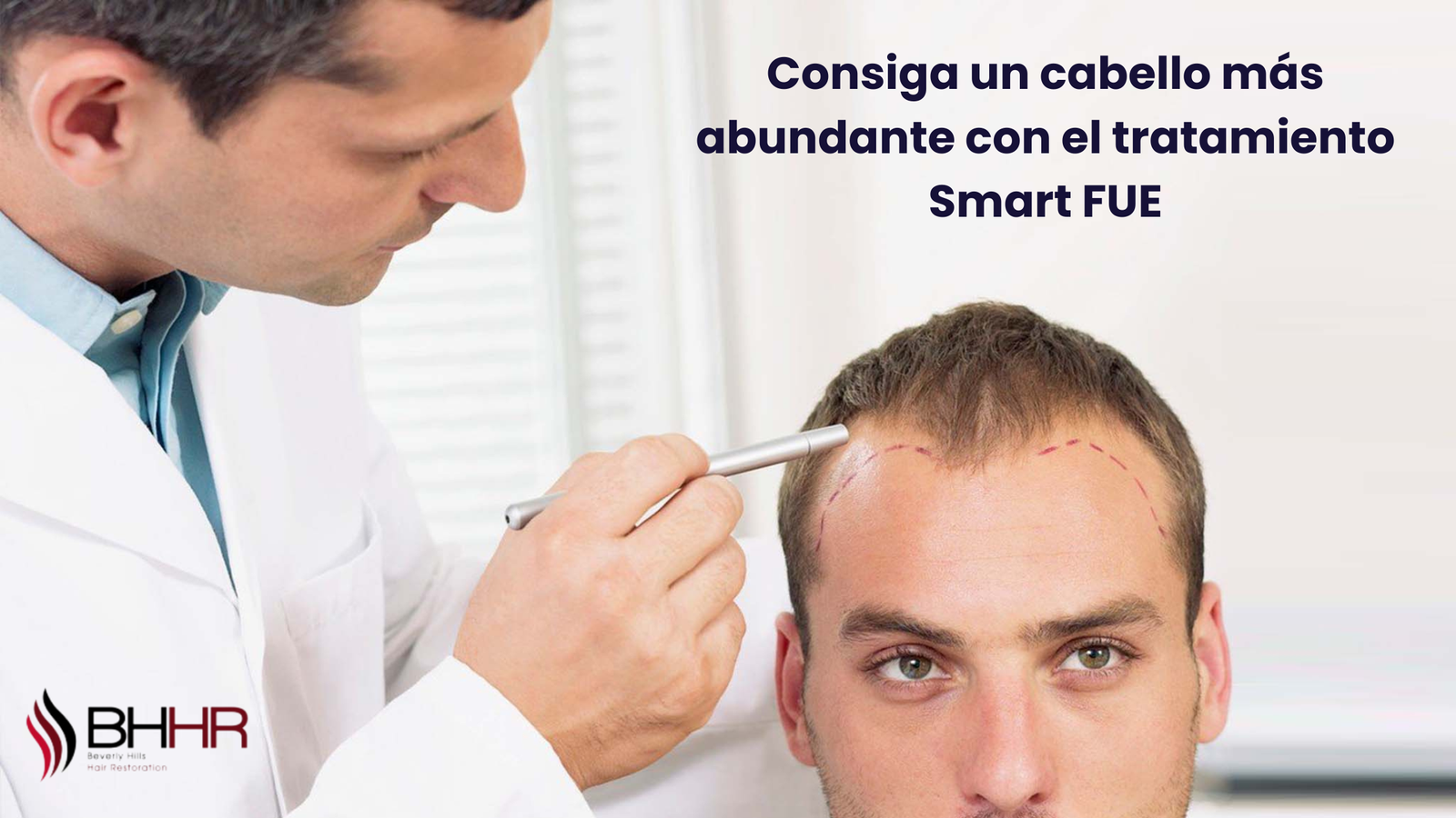 tratamiento Smart FUE