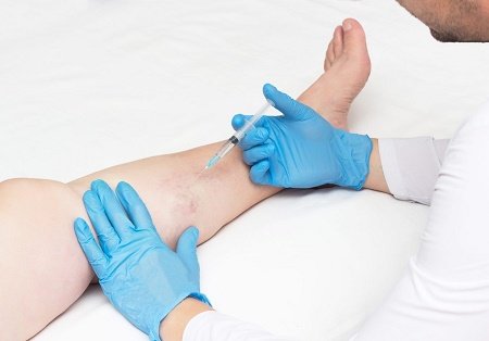 what is a varicose vein specialist called