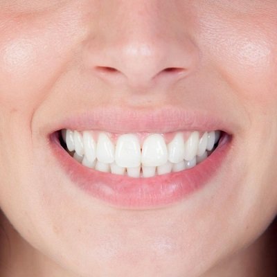 Is Zoom Teeth Whitening Right for You? Pros and Cons