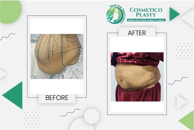 Tummy Tuck Surgery in Lahore