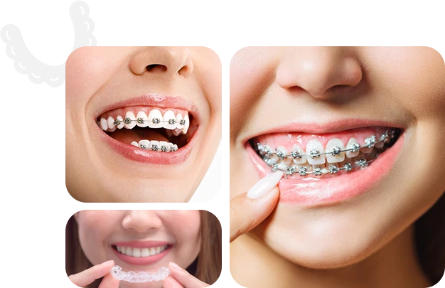 invisalign braces